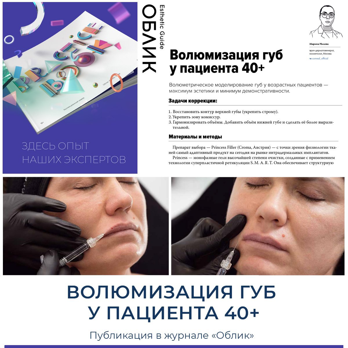 Волюмизация губ у пациента 40+